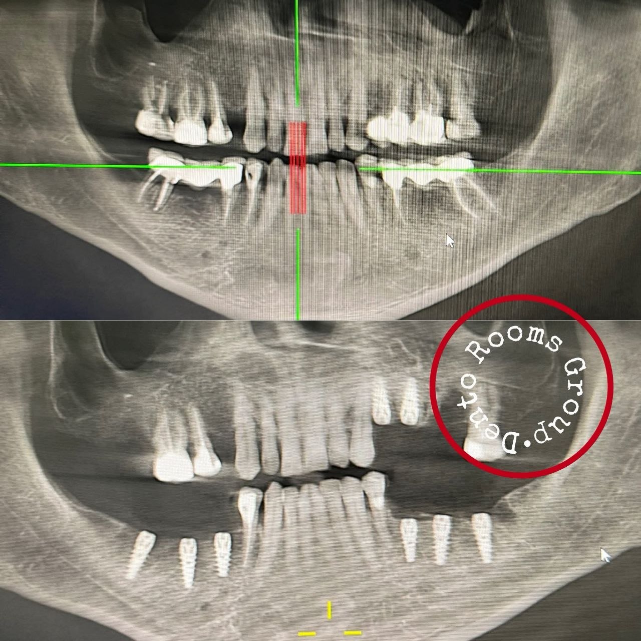 CBCT დაგეგმვის სურათი და დასრულებული იმპლანტაციის შემთხვევა